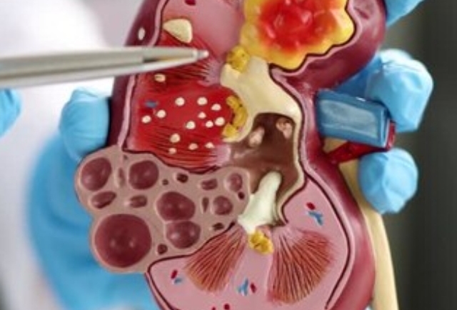 Kidney Stones? Avoid These Common Supplements That Could Trigger a Painful Flare-Up!