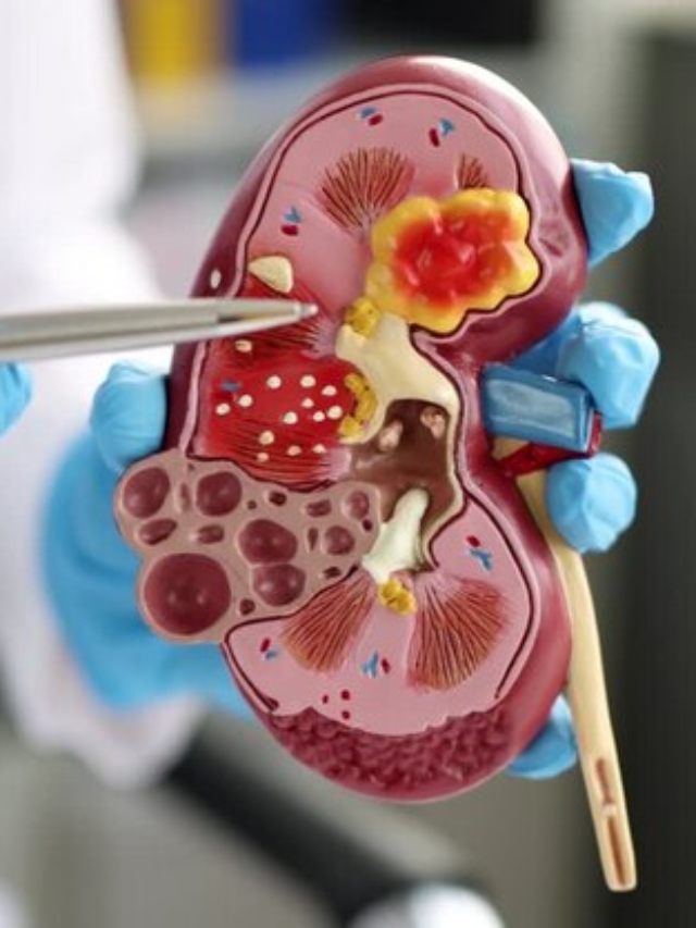 Kidney Stones? Avoid These Common Supplements That Could Trigger a Painful Flare-Up!